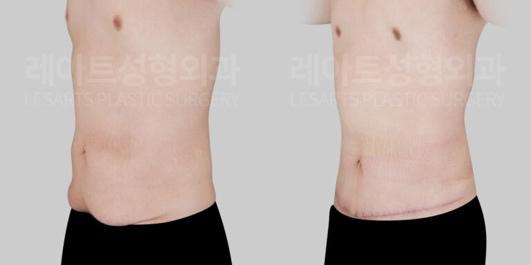 lesarts male abdominoplasty before and after