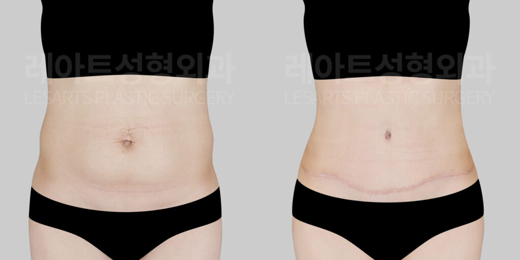 abdominoplasty before and after(lesarts)