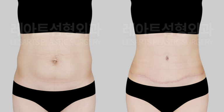 abdominoplasty before and after(lesarts)