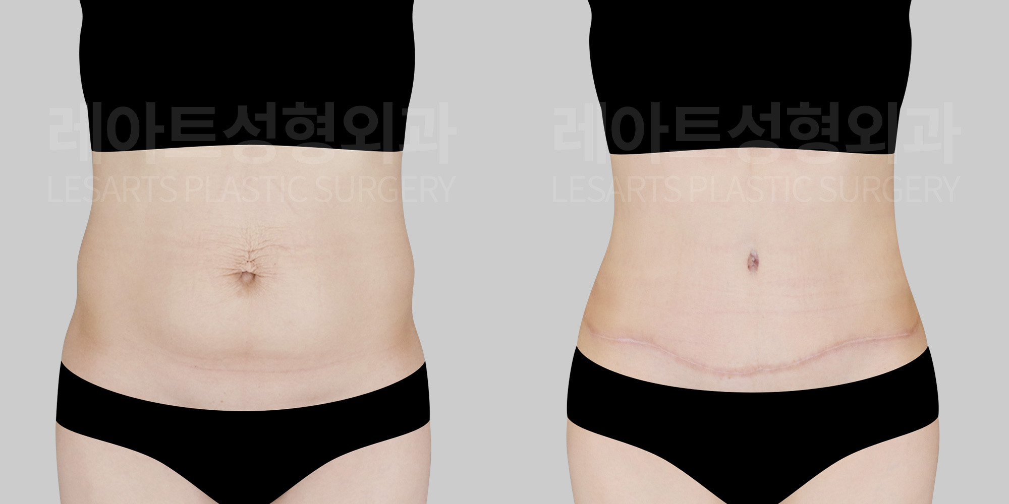 abdominoplasty before and after(lesarts)