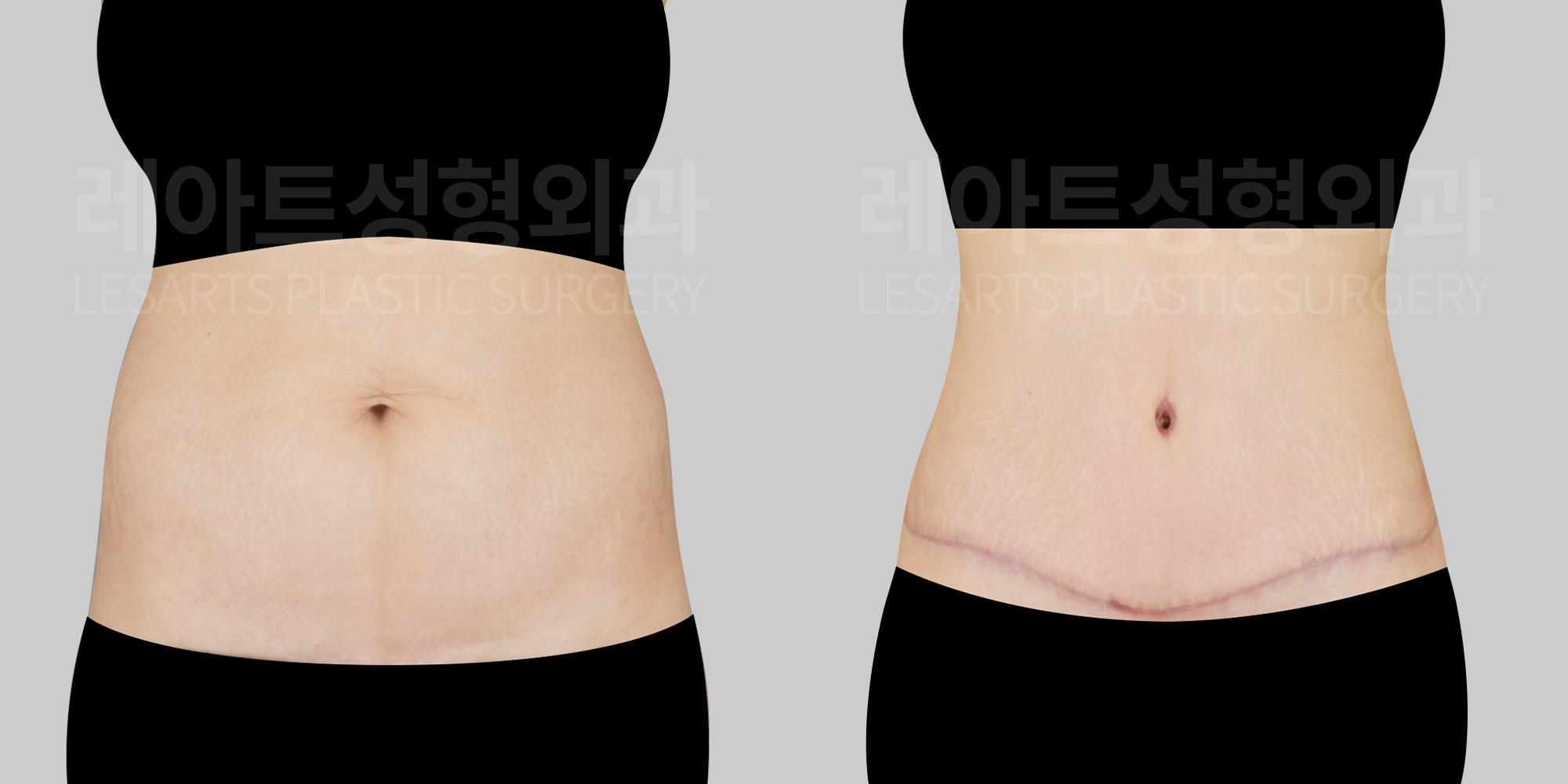 abdominoplasty-31288-bna-front