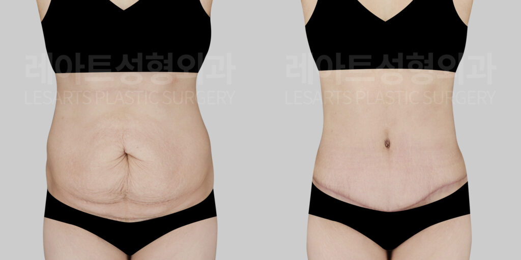 abdominoplasty before and after(lesarts)