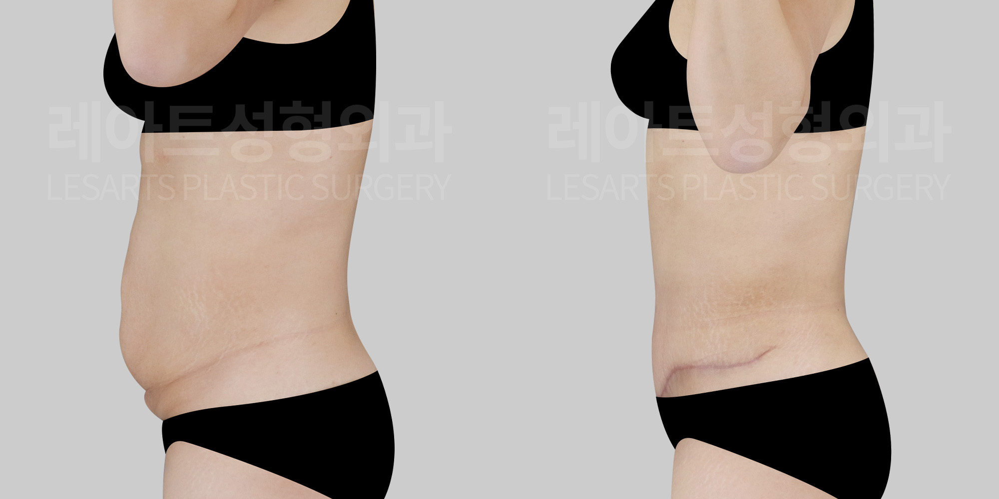 [Abdominal Liposuction] “The Skin Is Tightened, the Contour Is Sculpted”The Role of Abdominal LiposuctionWhen Combined with Abdominoplasty