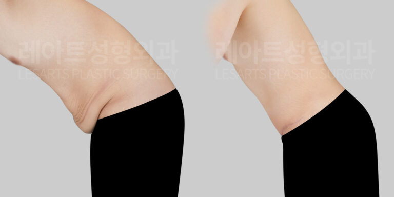 abdominoplasty-31818-bna-bending