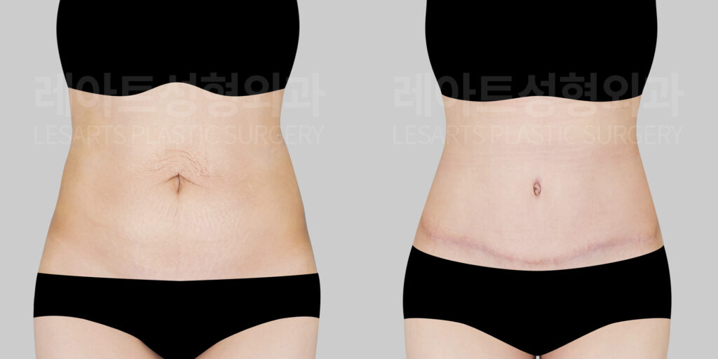 lesarts abdominoplasty before and after