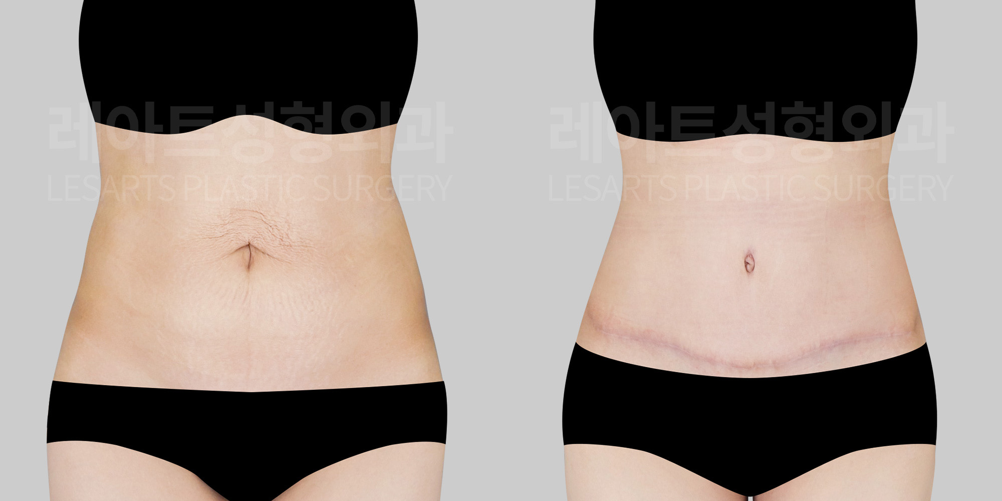 lesarts abdominoplasty before and after