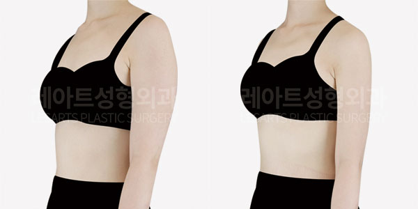 arm liposuction before and after