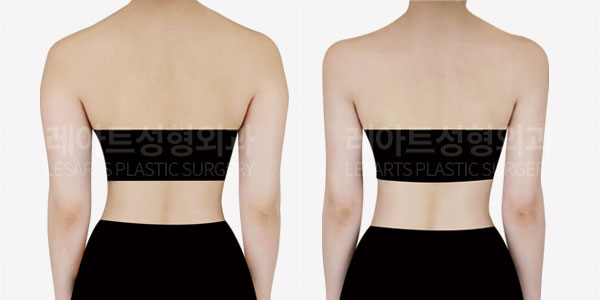 arm-liposuction-01-thumbnail-260602