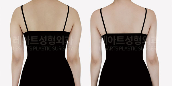 arm liposuction before and after-lesarts plastic surgery
