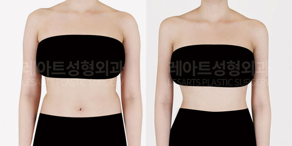 arm liposuction before and after-lesarts plastic surgery