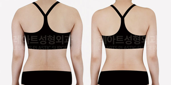 arm liposuction before and after-lesarts plastic surgery