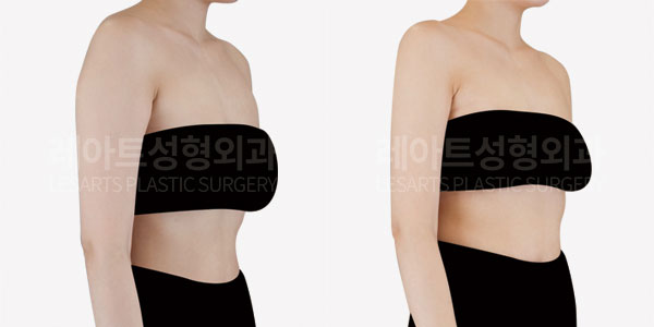 arm liposuction before and after-lesarts plastic surgery