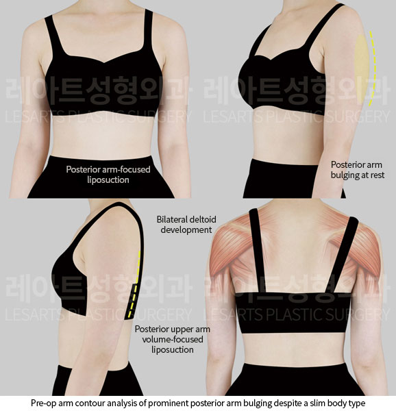 arm-liposuction-02-01-260601