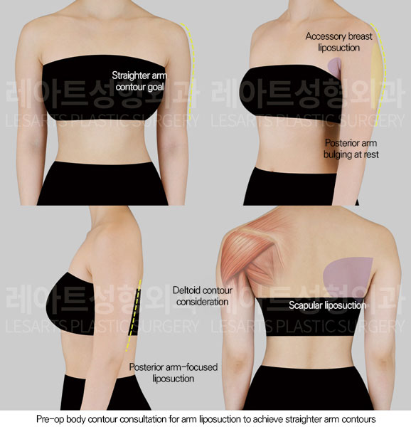 arm-liposuction-02-01-260602