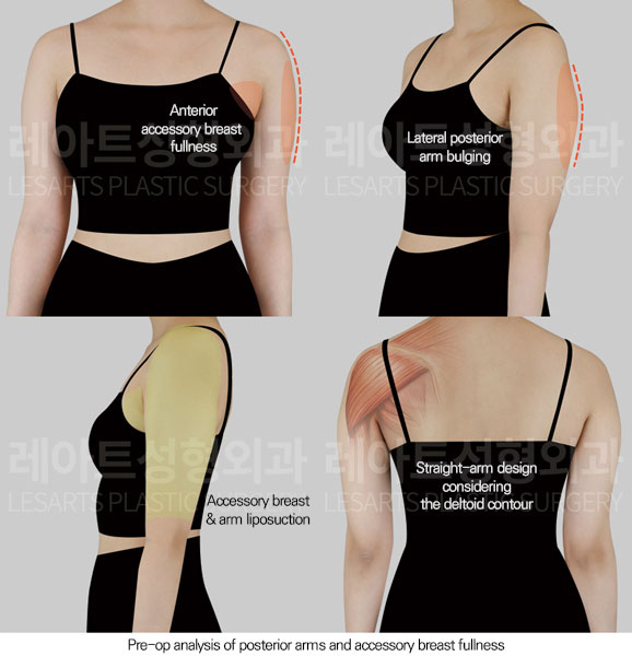 arm-liposuction-02-01-260605