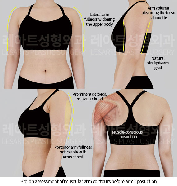 arm-liposuction-02-01-260618