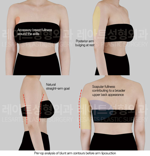 arm-liposuction-02-01-260623