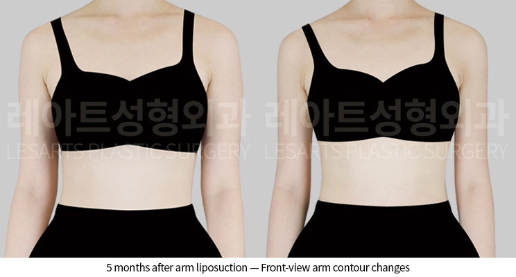 arm-liposuction-02-02-260601