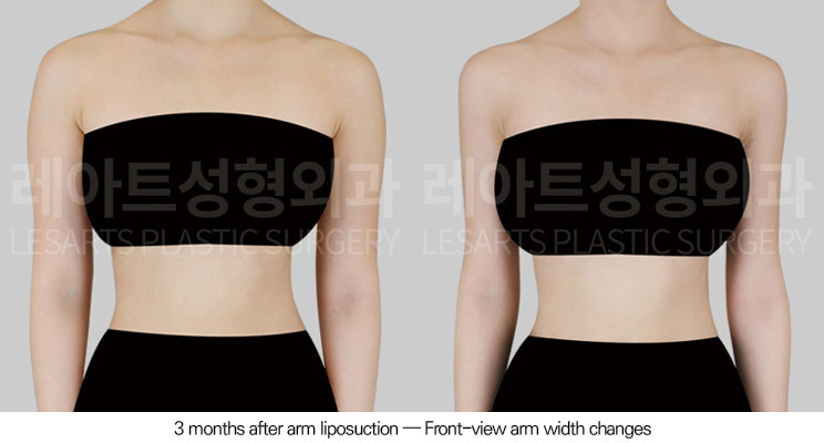 arm-liposuction-02-02-260602