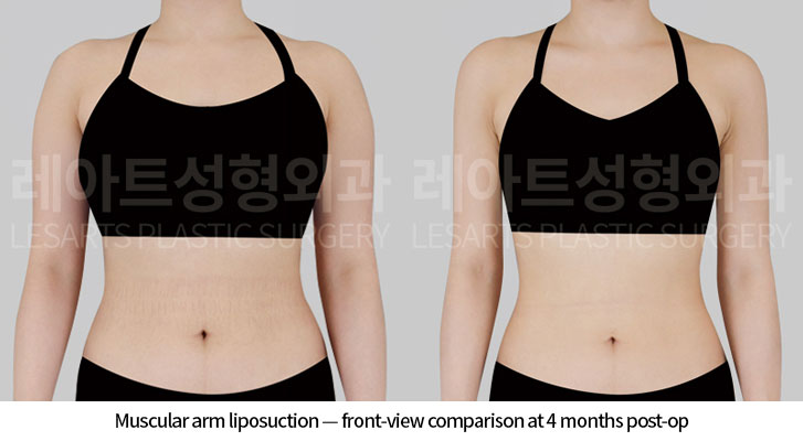 arm-liposuction-02-02-260618