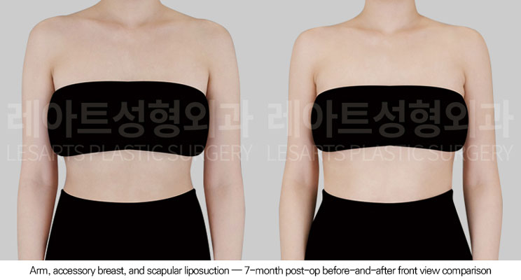 arm-liposuction-02-02-260623