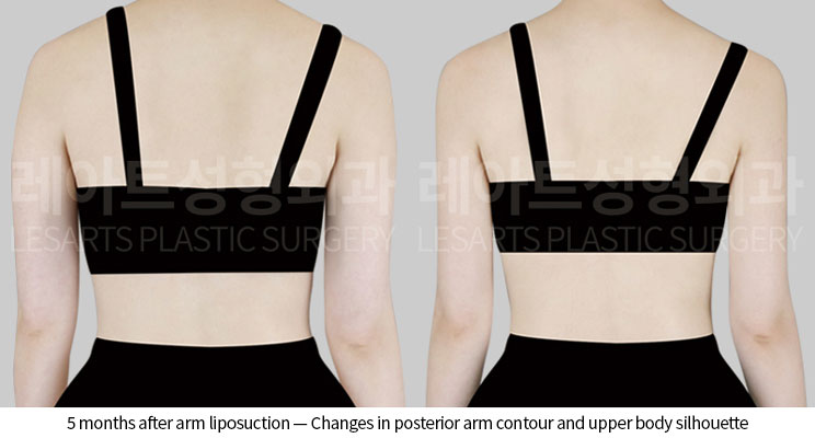 arm-liposuction-02-03-260601