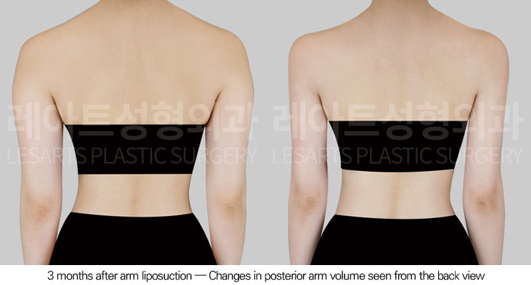 arm-liposuction-02-03-260602
