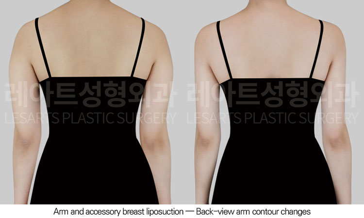 arm-liposuction-02-03-260605