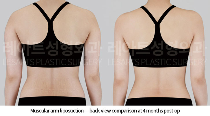 arm-liposuction-02-03-260618