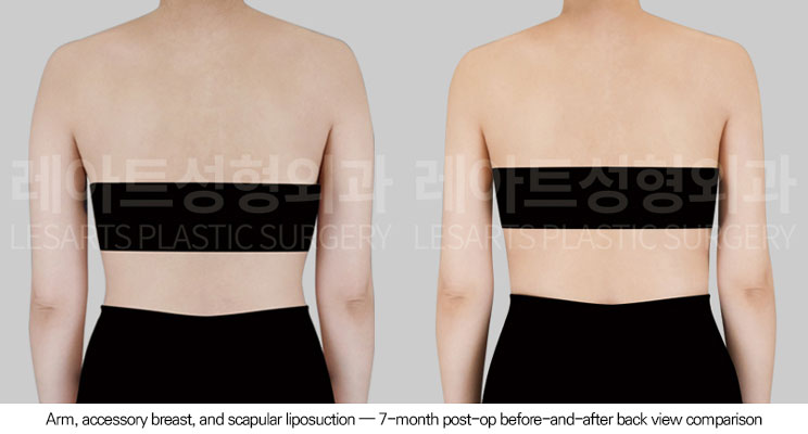 arm-liposuction-02-03-260623