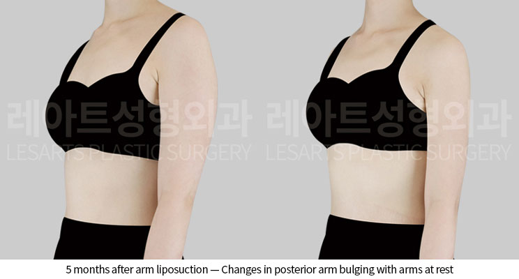 arm-liposuction-02-04-260601