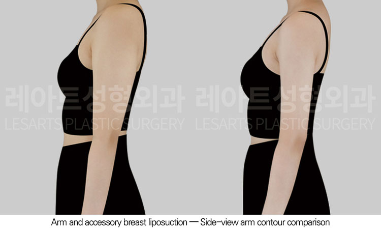 arm-liposuction-02-04-260605