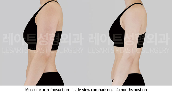 arm-liposuction-02-04-260618