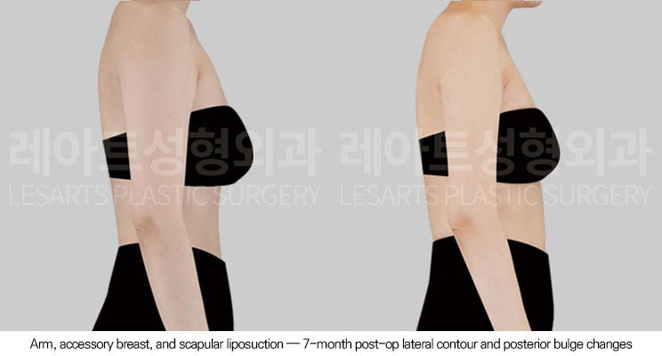 arm-liposuction-02-04-260623