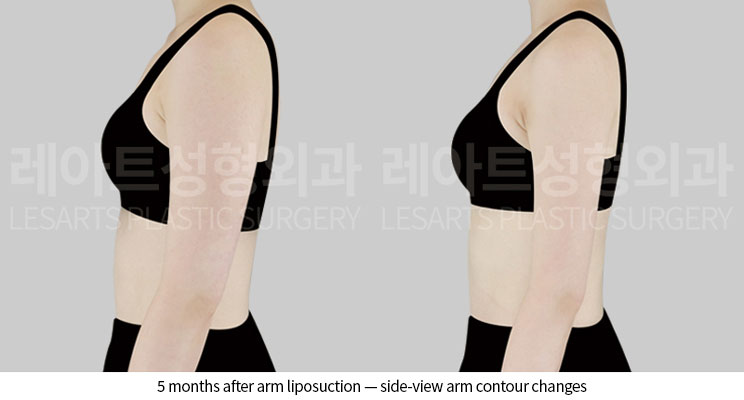 arm-liposuction-02-05-260601