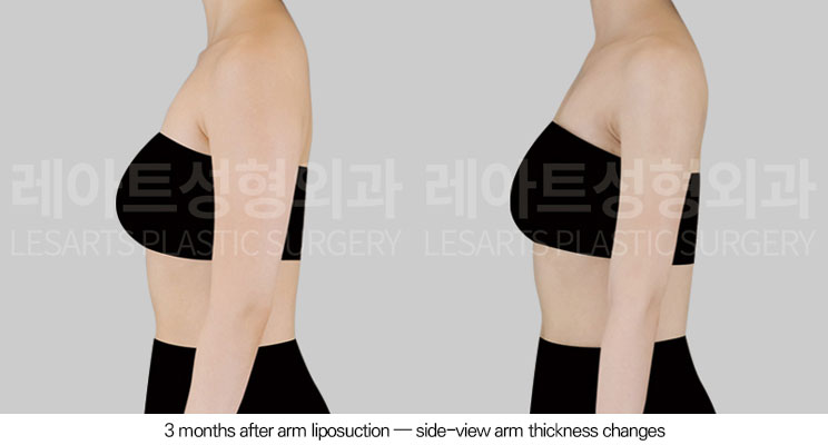 arm-liposuction-02-05-260602