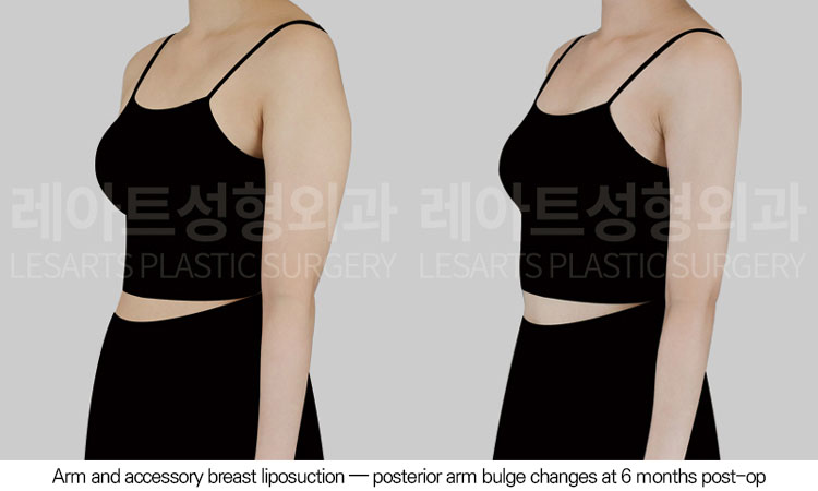 arm-liposuction-02-05-260605