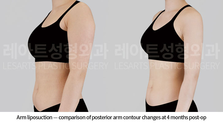 arm-liposuction-02-05-260618