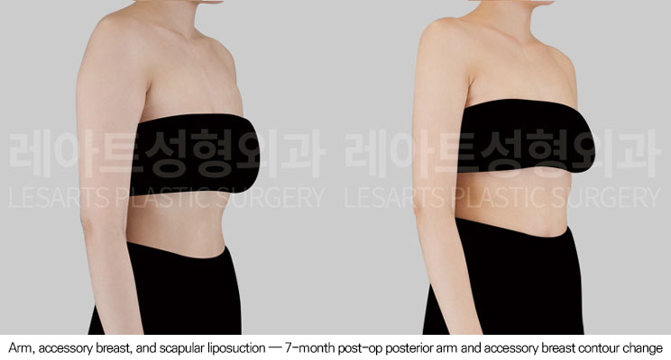 arm-liposuction-02-05-260623