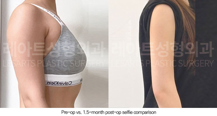 arm-liposuction-02-06-260602