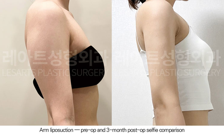 arm-liposuction-02-06-260605