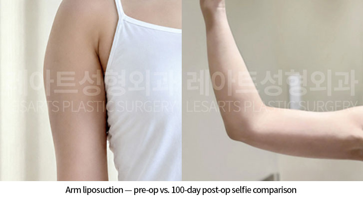 arm-liposuction-02-06-260618