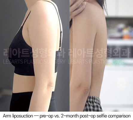 arm-liposuction-02-06-260623