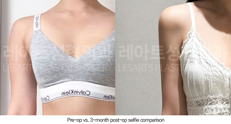 arm-liposuction-02-07-260602
