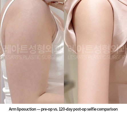 arm-liposuction-02-07-260618