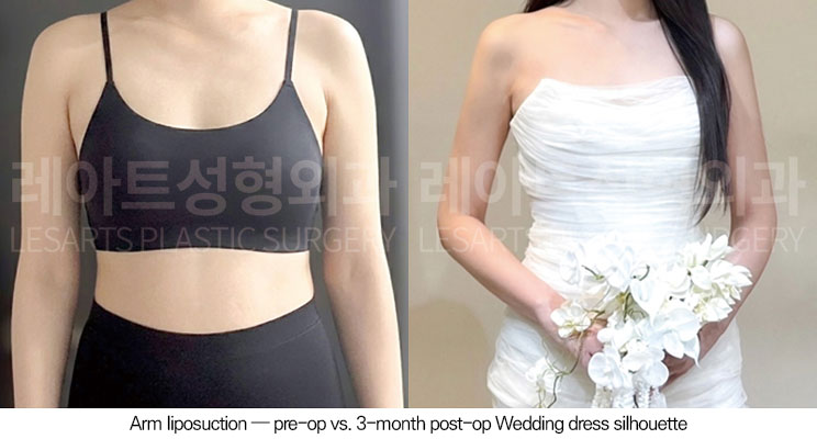 arm-liposuction-02-08-260623