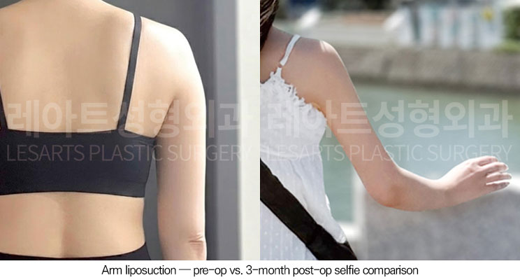 arm-liposuction-02-09-260623