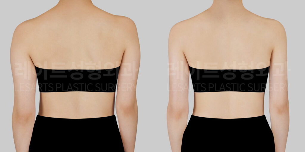 arm-liposuction-31769-bna-back