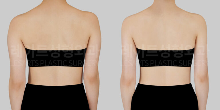 arm-liposuction-31769-bna-back