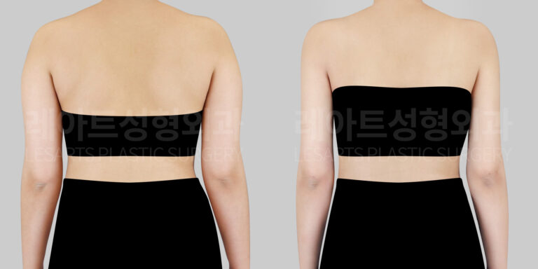 Arm, Back Liposuction Before and After - Lesarts Plastic Surgery
